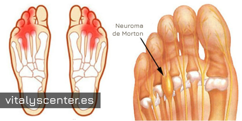 ¿Qué es el neuroma de Morton?