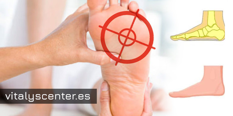 ¿Qué son los pies planos?