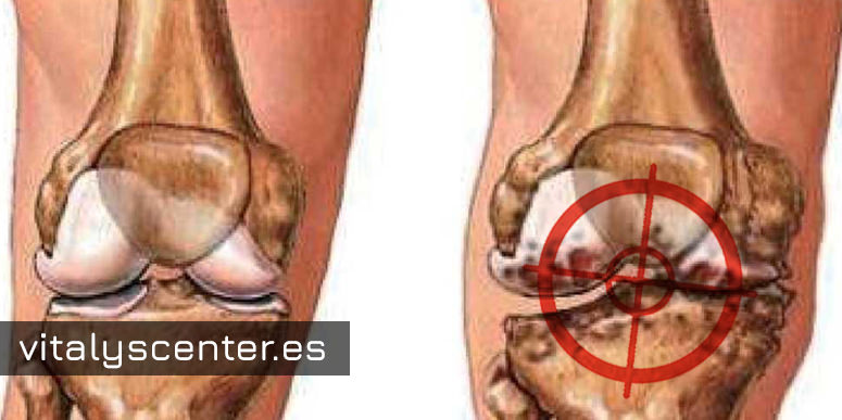 Que es la artrosis de rodilla