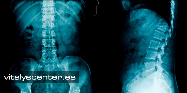 ¿Qué es la Escoliosis?