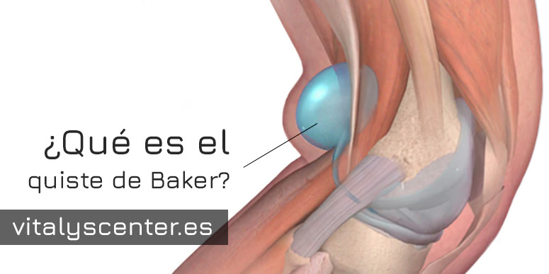 Qué es un quiste de Baker